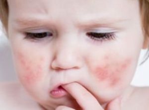 Быстрое и безопасное лечение диатеза на щеках у ребенка: лекарства и рецепты народной медицины