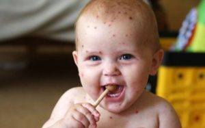 Цитомегаловирус у детей: симптомы и лечение опасного вируса