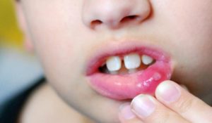 Афтозный стоматит у детей: лечение с помощью медикаментов и народных рецептов